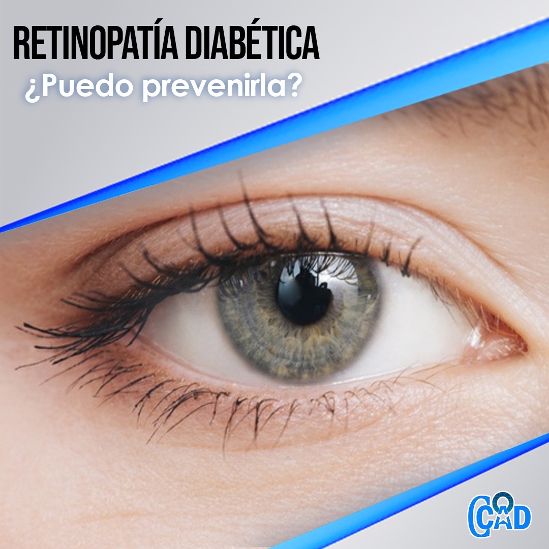 Retinopatía Diabética, puedo prevenirla?
